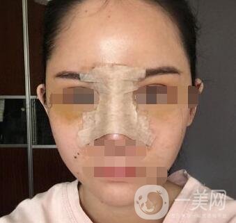 隆鼻固定膠帶幾天去掉？術(shù)后6天去掉會不會太早？