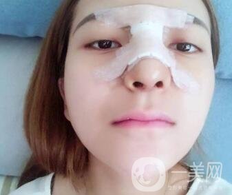 隆鼻固定膠帶幾天去掉？術(shù)后6天去掉會不會太早？