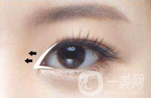 開(kāi)眼角眼睛會(huì)變大嗎？眼睛會(huì)變長(zhǎng)嗎？