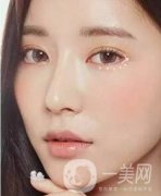 開(kāi)眼角前后照片圖，放大眼睛不是一點(diǎn)點(diǎn)