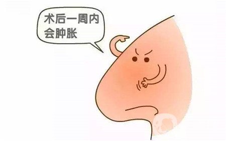 隆鼻手術(shù)恢復要多久才能自然？這期間要注意什么？