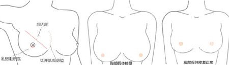 隆胸失敗之后應(yīng)該怎么處理？怎樣修復(fù)？