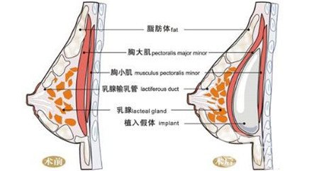 曼托假體和麥格假體哪種手感更好？教你怎么選擇？