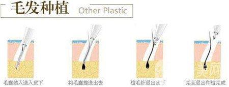 毛發(fā)種植費用大概要多少錢？