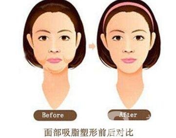 面部抽脂之后皮膚會變得松弛嗎？