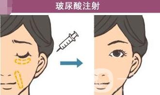 注射玻尿酸危害大嗎?有沒(méi)有毀容的風(fēng)險(xiǎn)?
