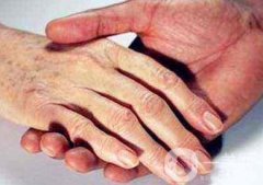 怎樣去掉手上的老年斑？還會(huì)再生嗎？