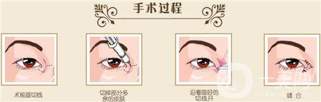 韓式開眼角多少錢？普遍價位是多少？