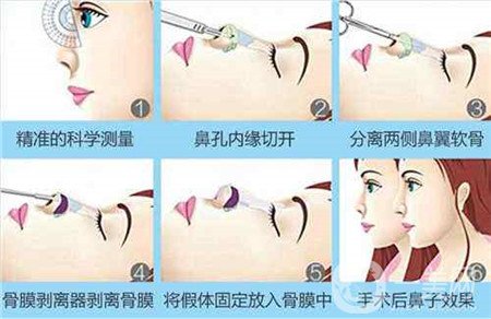 膨體隆鼻術(shù)后注意事項有哪些？需要忌口嗎？