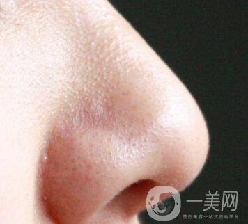 鼻子長(zhǎng)黑頭怎么辦？做激光有用嗎？