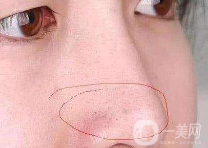 鼻子長(zhǎng)黑頭怎么辦？做激光有用嗎？
