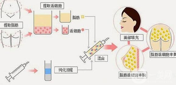 自體脂肪填充的價(jià)格是怎么計(jì)費(fèi)的?