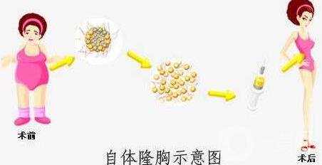 自體脂肪填充豐胸的風(fēng)險有哪些?弊端有哪些?