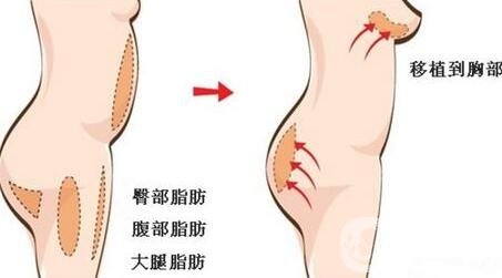 自體脂肪填充豐胸的風(fēng)險有哪些?弊端有哪些?
