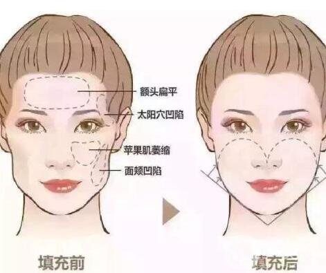 自體脂肪填充臉部會(huì)痛嗎?風(fēng)險(xiǎn)有哪些?