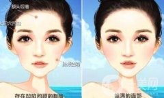 自體脂肪填充是局麻還是全麻呢?