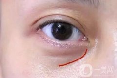 淚溝自體脂肪填充術后有些腫正常嗎?會恢復嗎?
