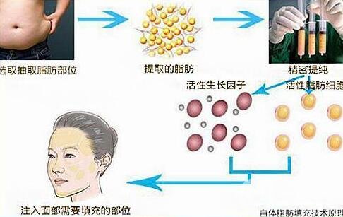 自體脂肪填充介紹?全國哪些機(jī)構(gòu)做得好?