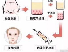 自體脂肪填充術(shù)前檢查及術(shù)后護(hù)理事項(xiàng)