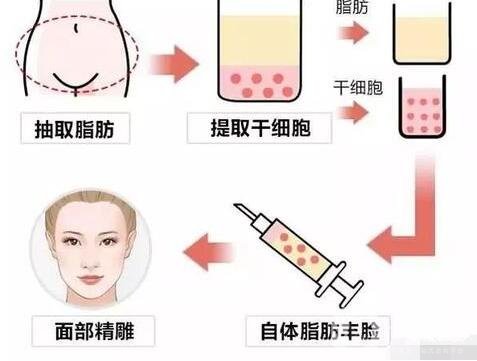 自體脂肪填充術前檢查及術后護理事項