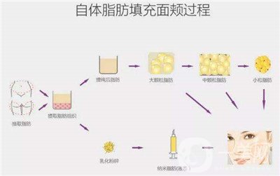 北京自體脂肪填充醫(yī)院有哪些？好的有哪些？