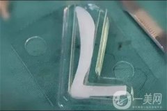假體隆鼻果如何？多久可以看到果呢？