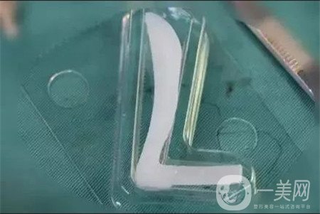 假體隆鼻*果如何？多久可以看到*果呢？