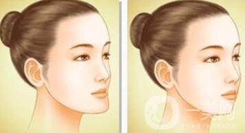 下巴突出怎么整？矯正手術(shù)原來是這么做的