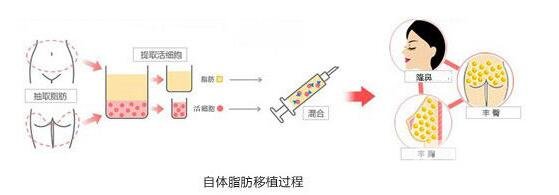 自體脂肪隆鼻缺點是什么?小白必知