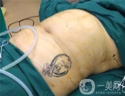 腰腹環(huán)吸后要腫多長(zhǎng)時(shí)間呢？可以活動(dòng)嗎？