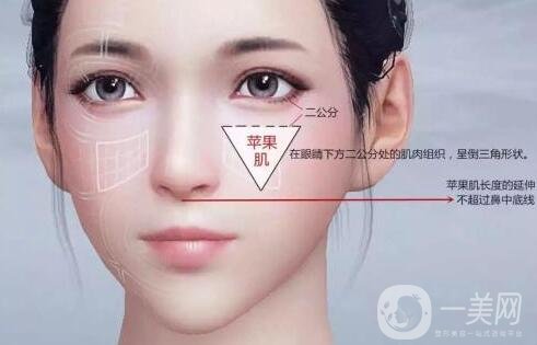 注射填充蘋果肌之后能笑嗎?會僵硬嗎?