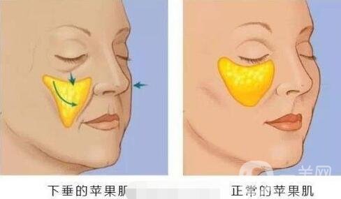 注射填充蘋果肌之后能笑嗎?會僵硬嗎?
