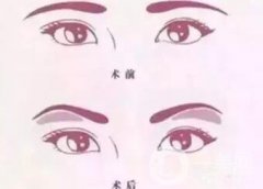 玻尿酸眉弓填充怎么打？會(huì)下滑嗎？
