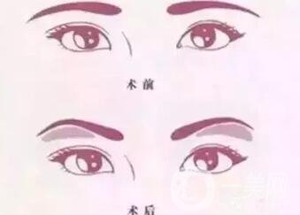 玻尿酸眉弓填充怎么打？會下滑嗎？