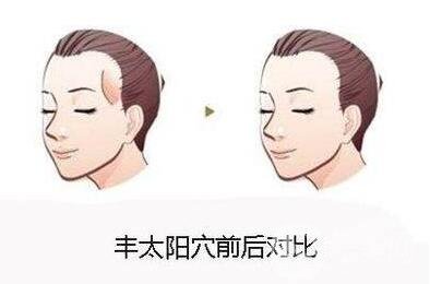 自體脂肪填充太陽(yáng)穴危險(xiǎn)嗎?有哪些風(fēng)險(xiǎn)可以提前規(guī)避?