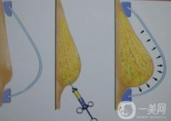 自體脂肪填充豐胸的價(jià)格要多少錢?