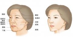 自體脂肪填充倆月后可以用洗面奶嗎?
