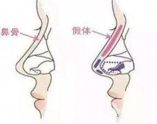 假體隆鼻需要多少錢?進(jìn)口的要多少錢?