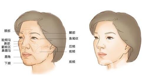 面部脂肪填充吃什么成活率高？
