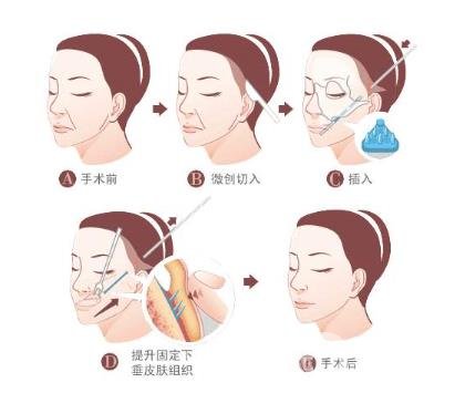 下筋膜懸吊祛皺術(shù)怎么操作的？*果嗎？