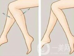 注射瘦臉瘦小腿一般多少錢？