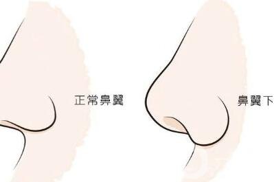 鼻翼缺損矯正*大嗎？要多少錢？