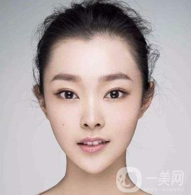 膨體隆下巴多久會變軟？容易取出來嗎？