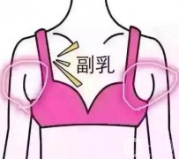 腋下副乳手術(shù)多少錢?價格影響因素有哪些?