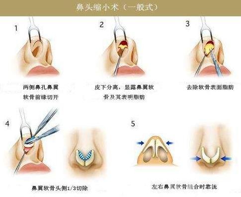 鼻頭肥大縮小術(shù)是持久*的嗎？