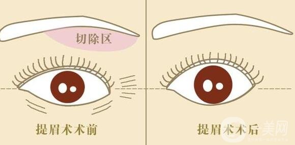 眉提升術適合哪些人?有什么方法