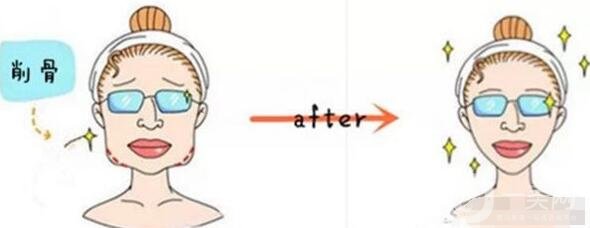 女人后縮下頜角整形變化有多大?