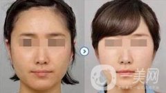打*臉會(huì)腫嗎？恢復(fù)期要多久？