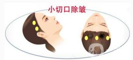 小切口除皺術(shù)后恢復(fù)過程是怎樣的？