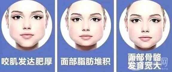 咬肌切除手術(shù)多少錢?有哪些影響因素?